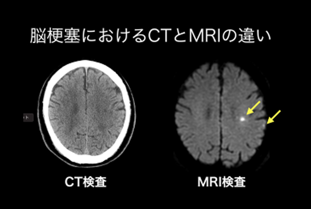 年齢別の脳卒中生存率