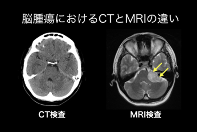 脳梗塞におけるCTとMRIの違い